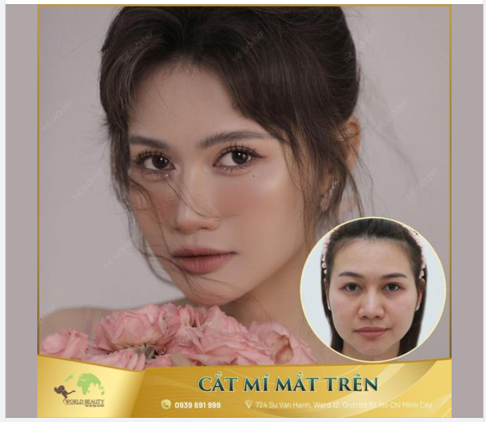 Mí mắt quý Cô đã từng can thiệp phẫu thuật nhấn mí một lần trước đó, hiện tại với tình trạng vài khuyết điểm: