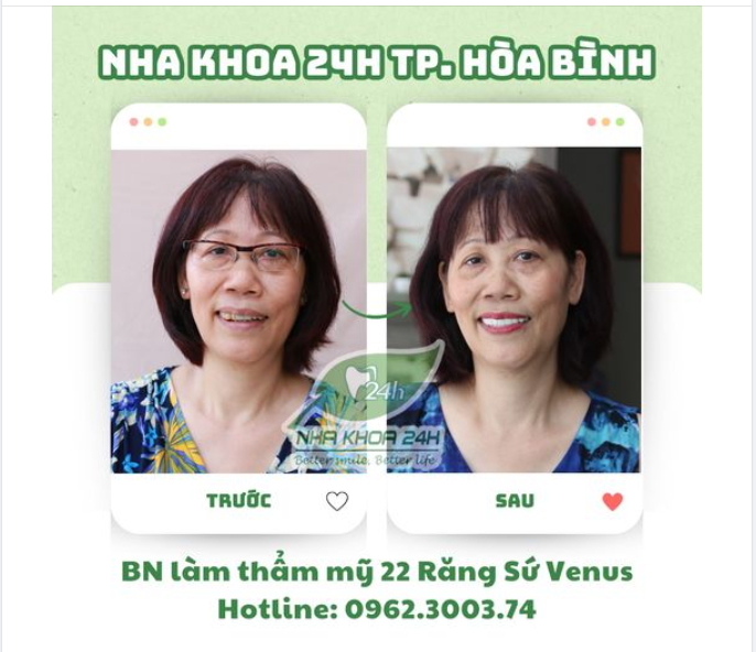 THỜI ĐIỂM VÀNG LÀM ĐẸP NỤ CƯỜI – XINH LUNG LINH ĐÓN TẾT