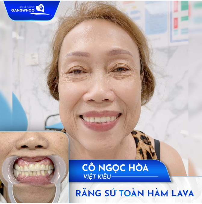 RĂNG CHẮC KHỎE ĂN NHAI THOẢI MÁI VỚI BẮC CẦU RĂNG SỨ LAVA RĂNG HÀM