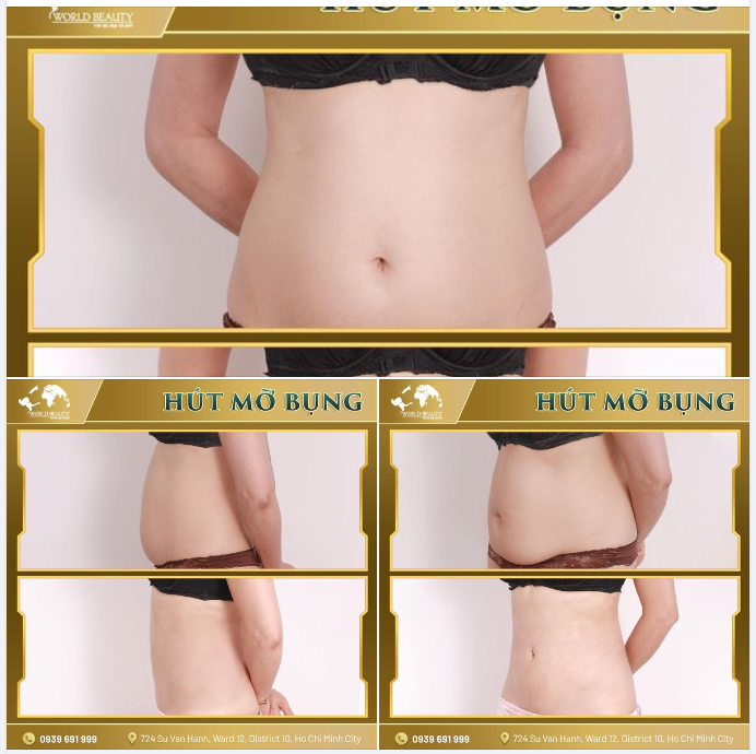 Hút mỡ Body Jet Evo - Giải pháp giúp lấy lại Body chữ S quyến rũ ngay tức thì cho quý Chị em sau sinh quá khổ v.òng 2, ít vận động, không có thời gian đầu tư cho thể thao dẫn đến m.ỡ lâu năm khó giảm.