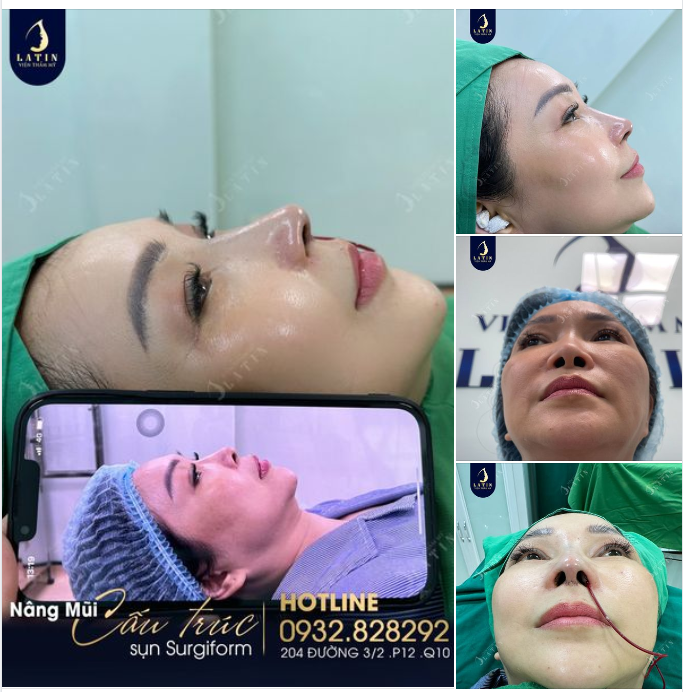 Ở xa về Việt Nam nâng mũi, bao lâu thì đi máy bay được
