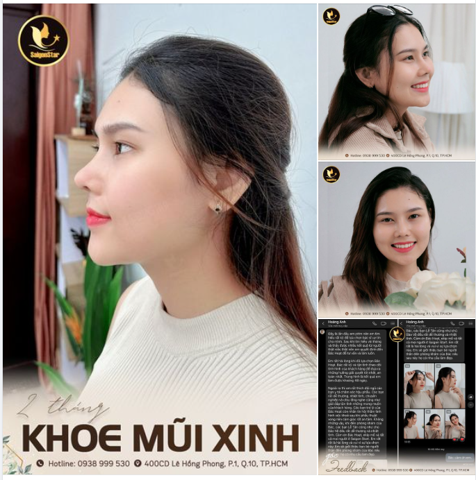 2 THÁNG KHOE MŨI XINH – 10 ĐIỂM THĂNG HẠNG NHAN SẮC