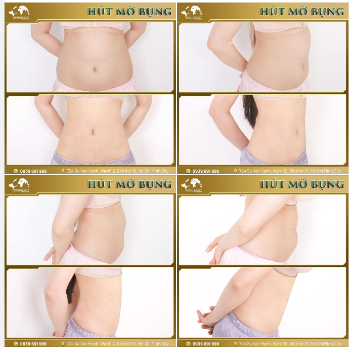 Hút mỡ bụng - một giải pháp dành cho những người có ngoại hình quá khổ, cơ địa khó giảm cân, phụ nữ sau sinh hoặc nam giới có chế độ ăn uống, sinh hoạt không lành mạnh.