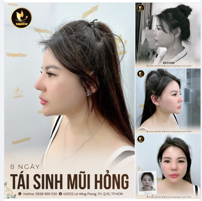 8 NGÀY – TÁI SINH MŨI HỎ.NG LẦN 4 PHỤC HỒI MŨI CO RÚT BIẾN DẠNG