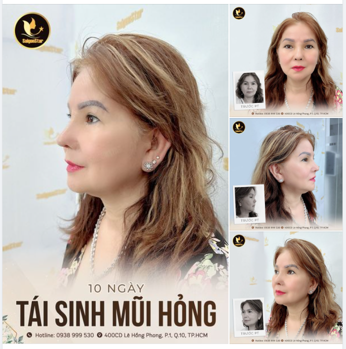 NÂNG MŨI LẦN THỨ 5 SẼ NHƯ THẾ NÀO? CẬP NHẬT KẾT QUẢ SAU 10 NGÀY TÁI SINH MŨI HỎNG