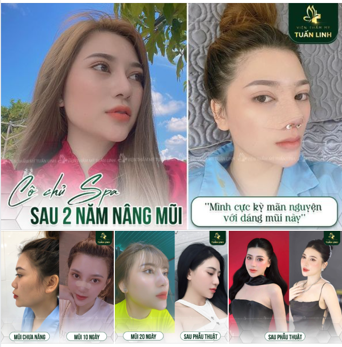 Cô chủ spa sau 2 năm nâng mũi!!