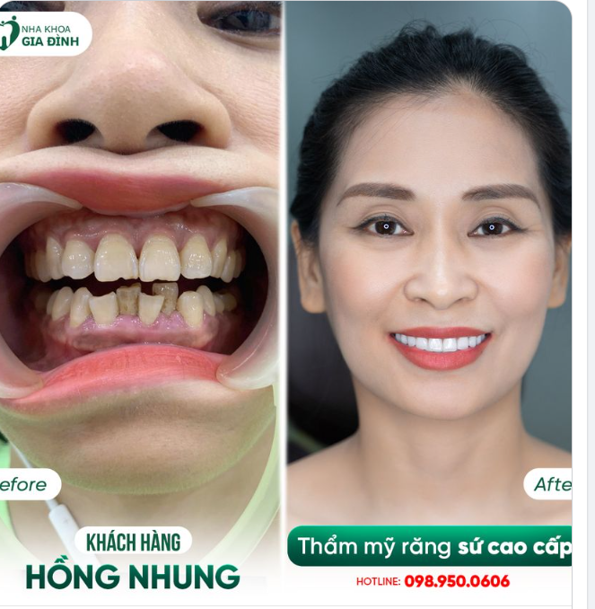 THẦN THÁI RẠNG NGỜI SAU KHI THAY ĐỔI NỤ CƯỜI