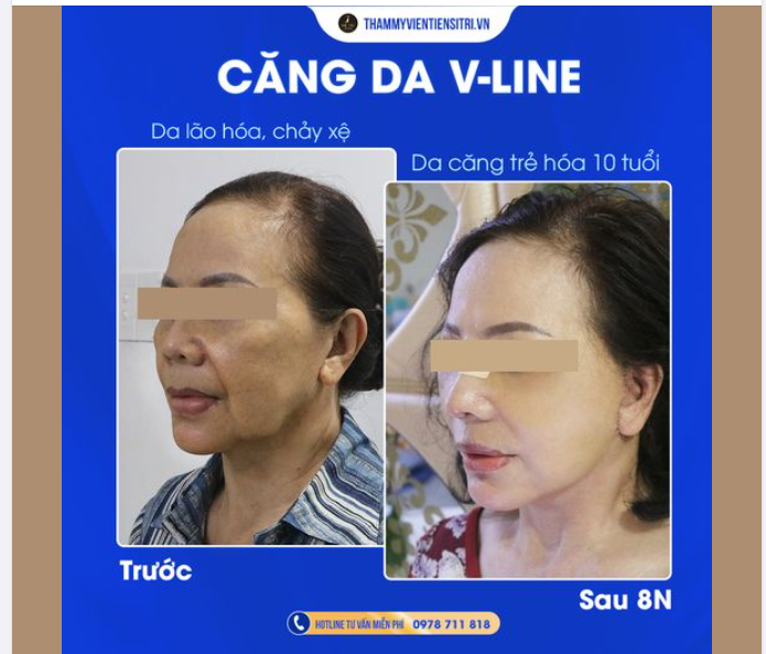 U60 CĂNG DA VLINE TRẺ HÓA KẾT QUẢ SẼ NHƯ THẾ NÀO??