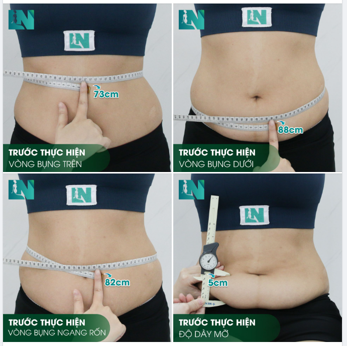 HÌNH ẢNH TRƯỚC KHI THỰC HIỆN HÚT MỠ TẠO DÁNG BỤNG - EO - HÔNG CỦA CHỊ THÚY