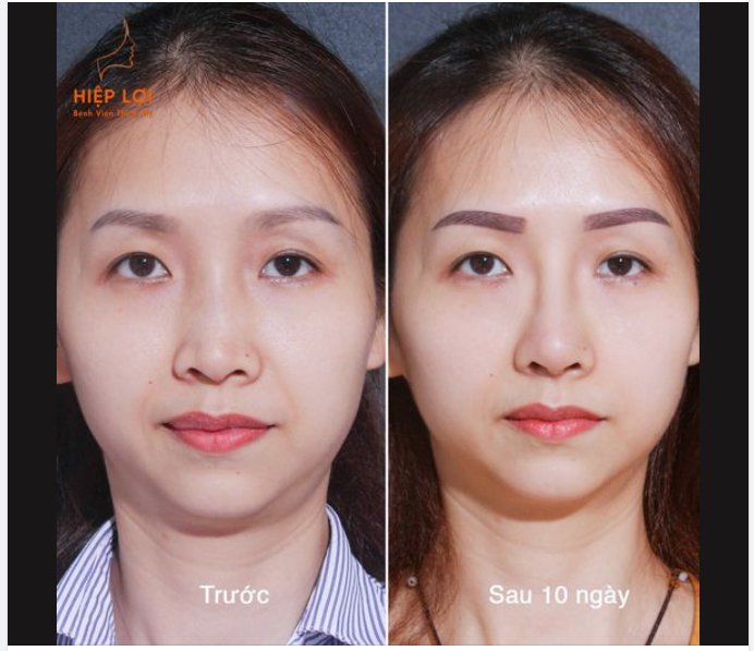 Chào tháng 12! Thời điểm này đi nâng mũi là vừa đẹp để đón tết 2024 đó ạ.