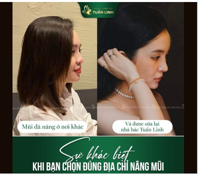 Lựa chọn đúng địa chỉ nâng mũi QUAN TRỌNG đến thế nào???