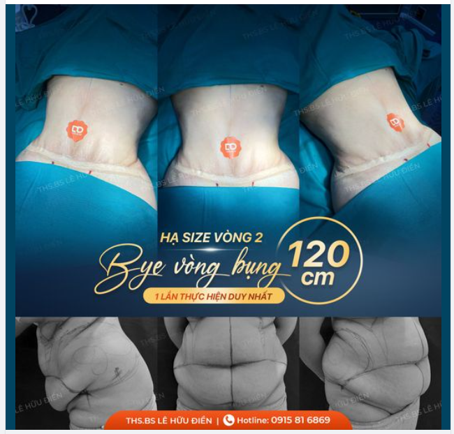 Bụng "bầu bé mỡ" Khổ sở về cả thể xác lẫn tinh thần.