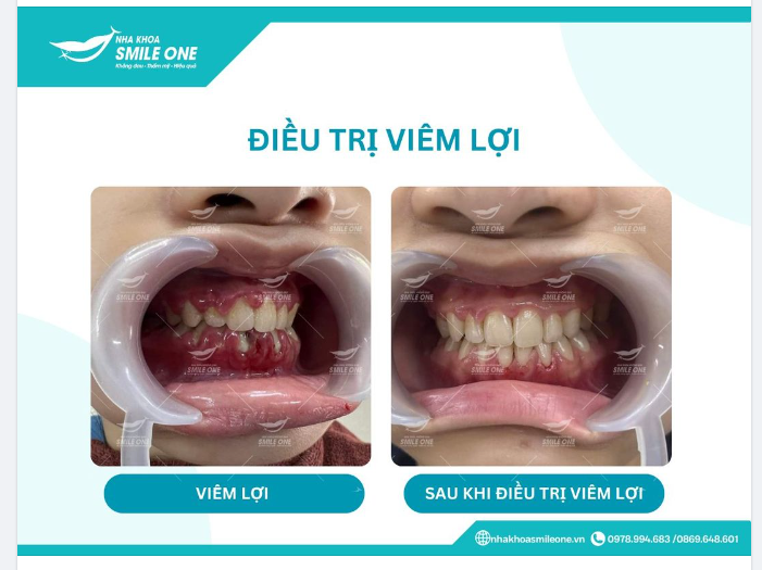Viêm lợi hình thành có thể do cao răng và các mảng bám tồn tại lâu trong miệng ở các chân, kẽ răng cùng với vi khuẩn gây bệnh.