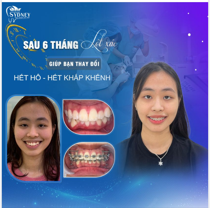 NIỀNG Ở ĐÂU? CHỌN NGAY NHA KHOA HÀ NỘI SYDNEY!