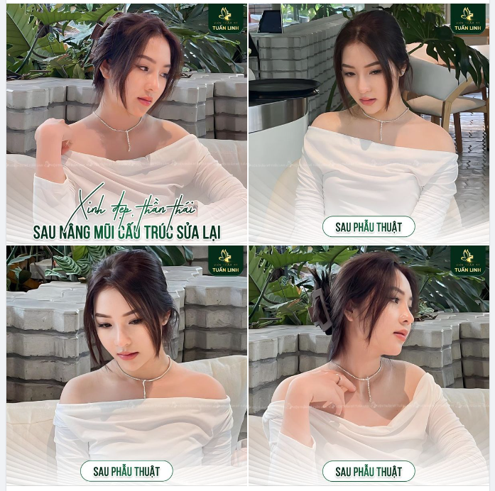 XINH ĐẸP, THẦN THÁI SAU NÂNG MŨI CẤU TRÚC SỬA LẠI !!