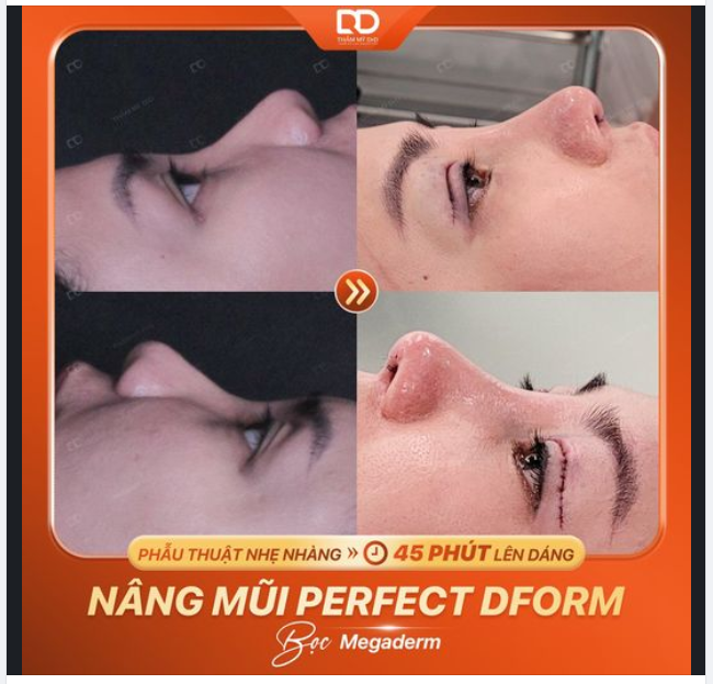 Cận cảnh kết quả dáng mũi sau 45 phút thực hiện.