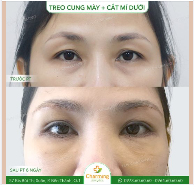 Phẫu thuật nâng cung mày có thể hỗ trợ bạn giải quyết một số vấn đề của mí trên ngoài công năng chính của nó là nâng đường cung mày. Nhưng đối với các vấn đề của mí dưới thì... thua. Thôi nào, đừng tham lam thế chứ