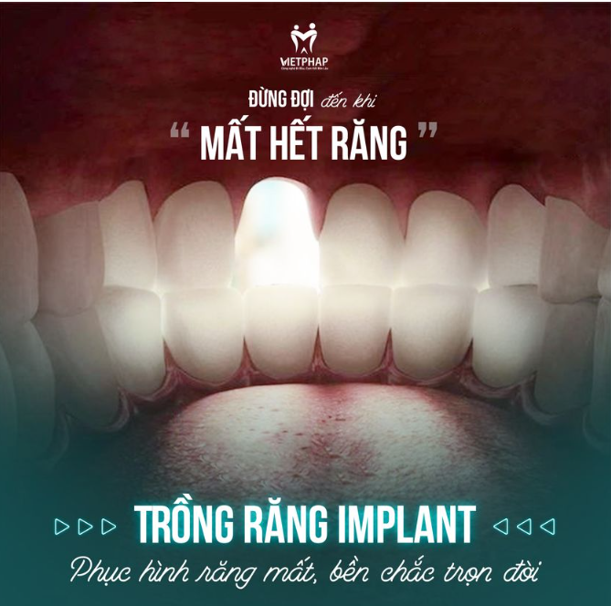 TRỒNG RĂNG IMPLANT - PHỤC HÌNH RĂNG MẤT, BỀN CHẮC TRỌN ĐỜI