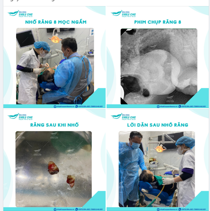 Ths Bs Nguyễn Tuấn Dương vừa kết thúc một ca nhổ răng khôn mọc ngầm đâm vào răng số 7 bên cạnh.