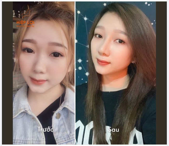 Mũi tẹt, mũi gãy tội gì mà không đi sửa cho đẹp?