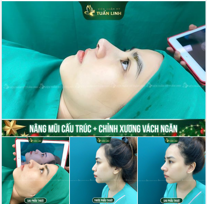 NÂNG MŨI XINH RINH THÊM TÀI LỘC