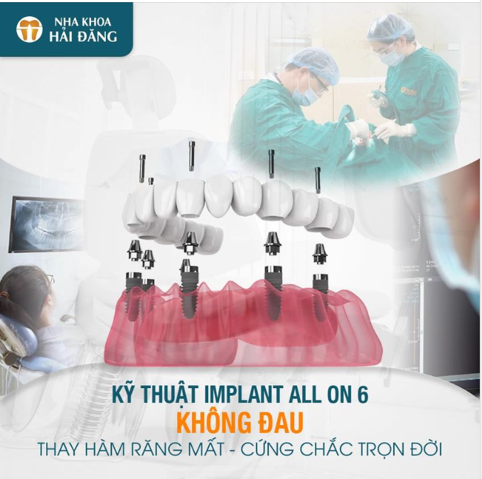 KỸ THUẬT IMPALNT ALL ON 6 THAY HÀM RĂNG MẤT- CỨNG CHẮC TRỌN ĐỜI