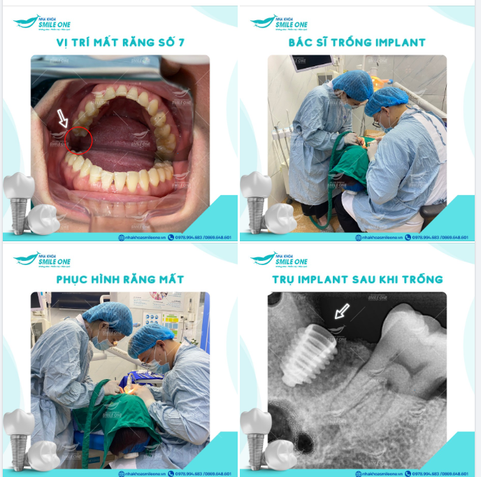 Bác sĩ Phạm Thanh Bình vừa kết thúc một ca trồng implant răng số 7 cho khách hàng Nguyễn Ngọc Hân 38 tuổi.