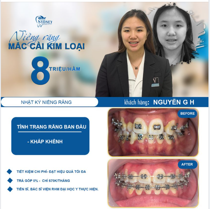 NIỀNG RĂNG KHẤP KHỂNH CÓ NÊN KHÔNG?