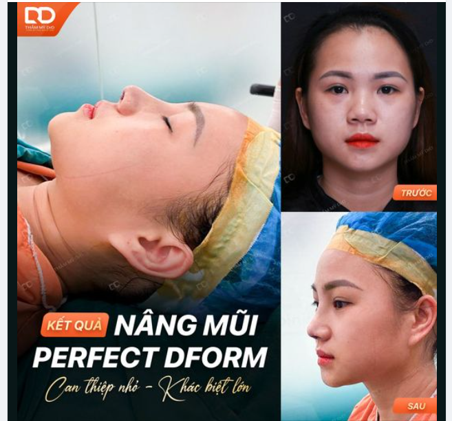 Khác biệt đến từ góc nghiêng. Thay diện mạo chỉ sau 45 phút Nâng mũi Perfect Dform.