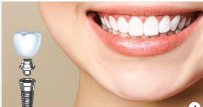 Khi nào nên và không nên cấy ghép Implant?