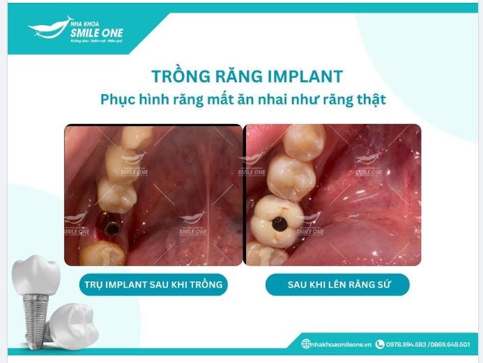 Trồng răng implant, phục hình răng mất, ăn nhai như răng thật.