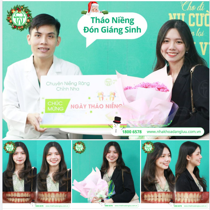 Chúc mừng Phương Trinh với nụ cười vô cùng đều đẹp, tự tin trong ngày tháo niềng.