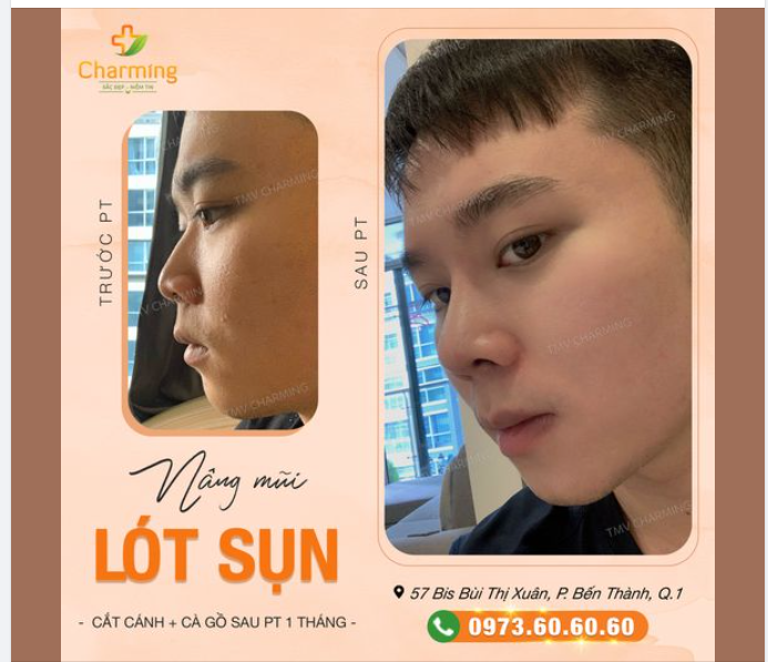 Ở nam giới đôi khi mũi thấp, gồ và cánh mũi to khiến cho khuôn mặt của bạn kém bắt mắt.