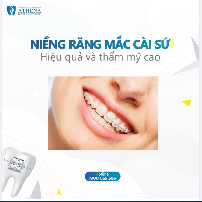 NIỀNG RĂNG MẮC CÀI SỨ - SỰ LỰA CHỌN HOÀN HẢO CHO NỤ CƯỜI TỰ TIN