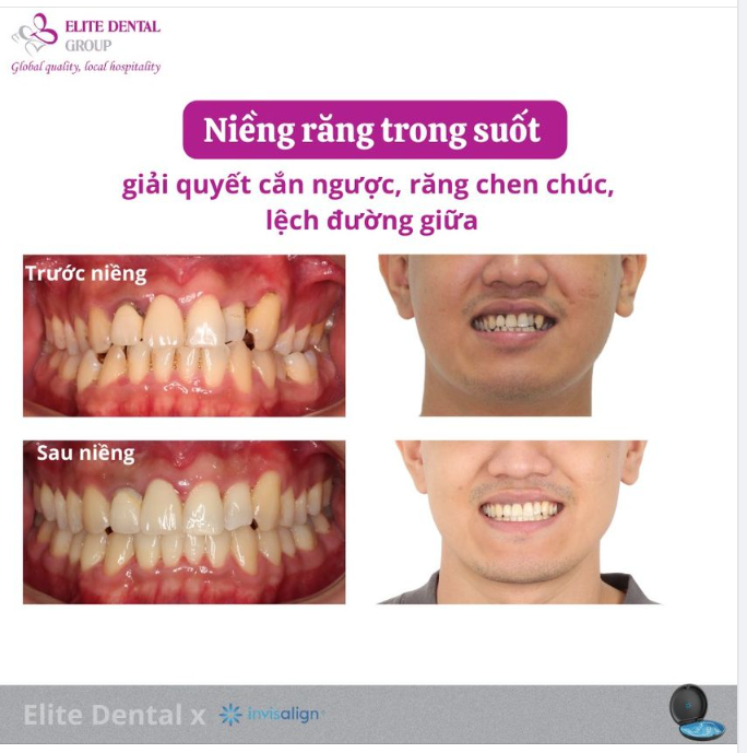 TÌNH TRẠNG CẮN NGƯỢC, RĂNG CHEN CHÚC, LỆCH ĐƯỜNG GIỮA