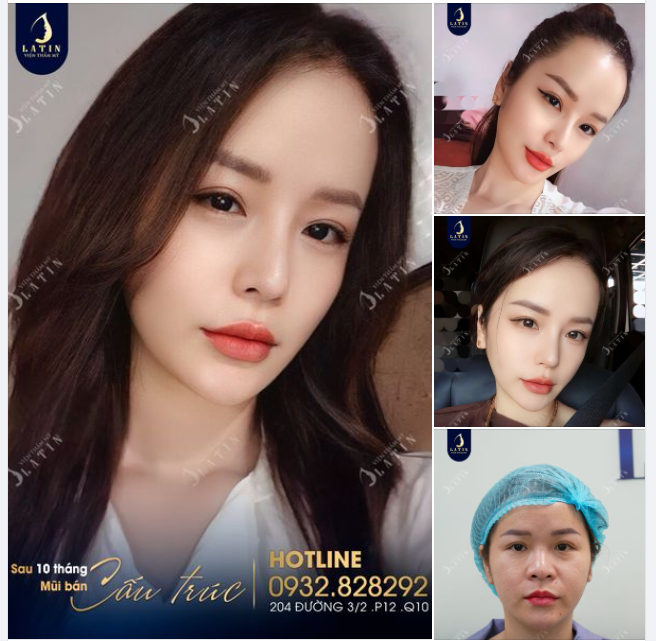 Flex nhan sắc sau 10 tháng nâng mũi tại Latin