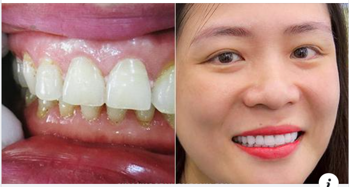 Vì Sao Viền Nướu Bị Đen Sau Khi Bọc Răng Sứ?