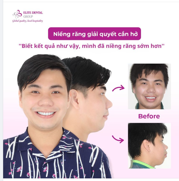 ‘’Niềng răng là một quyết định đúng đắn, phải chi mình niềng sớm hơn…’’