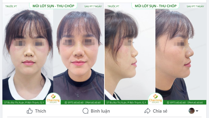 Dáng mũi Á Đông không hề hiếm những chiếc mũi có võng mũi như thế, thậm chí ở một số trường hợp võng mũi còn sâu hơn.