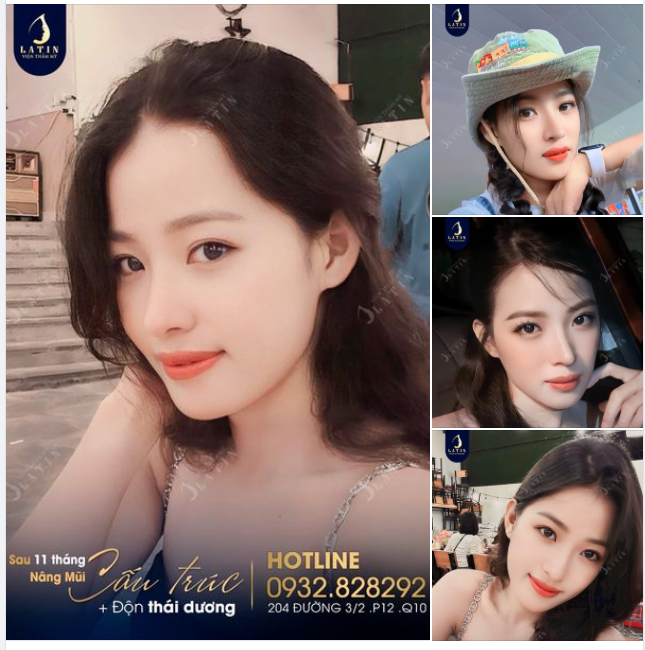"Sau gần 1 năm nâng mũi, em thấy mình may mắn hơn rất nhiều..."