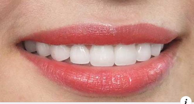 Bọc răng sứ giữ được bao lâu và hướng dẫn chăm sóc sau bọc răng