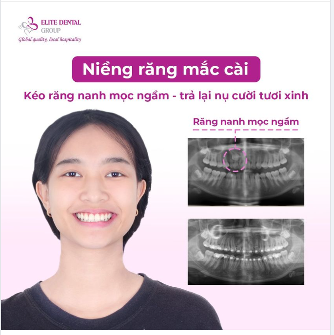 KÉO RĂNG NANH MỌC NGẦM, TRẢ LẠI NỤ CƯỜI TƯƠI XINH!