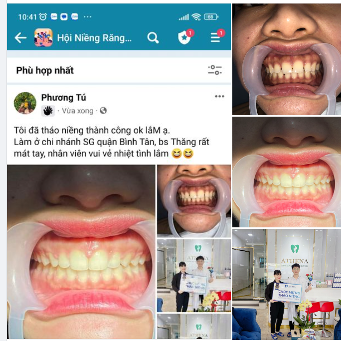 Chúc mừng Võ Thị Phương Tú đã thành công với hành trình tháo niềng tại Nha Khoa ATHENA!