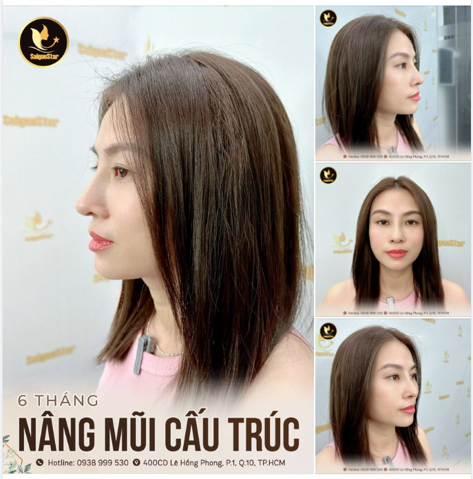 6 THÁNG NÂNG MŨI CẤU TRÚC KHỞI SẮC – KHỞI VẬN