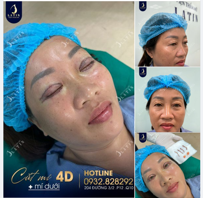 Trẻ hóa da vùng mắt cho chị gái đến từ Trà Vinh