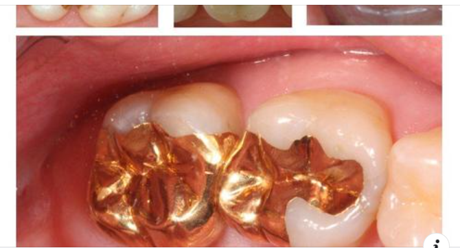 Chọn chất liệu trám phù hợp cho răng của bạn như thế nào