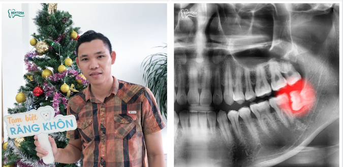 Răng khôn mọc lệch quá lâu, sẽ khó nhổ và làm hư răng bên cạnh!!!