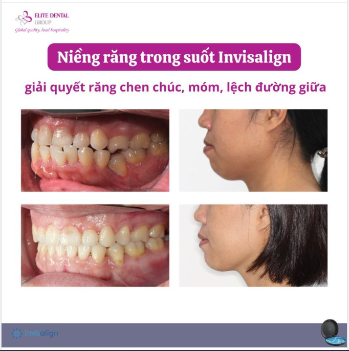 NIỀNG RĂNG TRONG SUỐT INVISALIGN