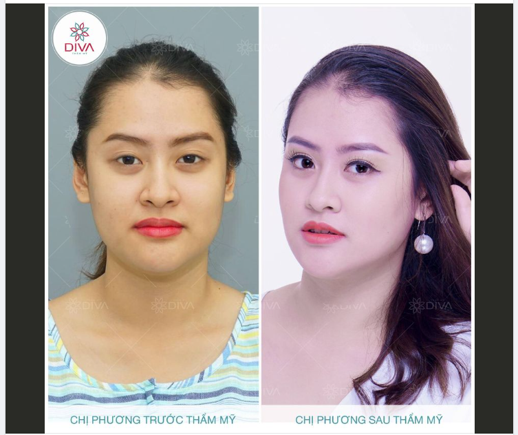 THẨM MỸ TÁCH TÚI MỠ MÁ TRONG ĐƠN GIẢN HAY PHỨC TẠP?
