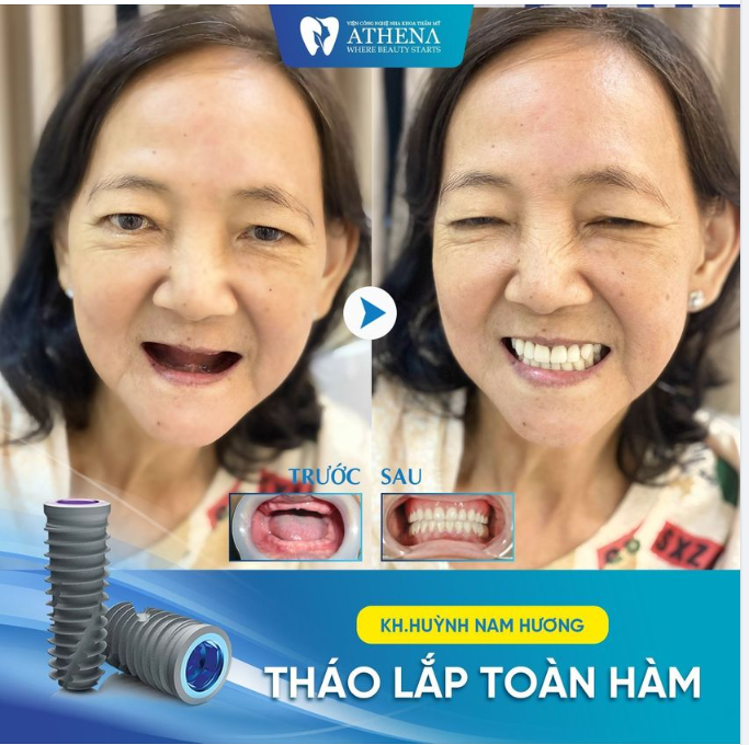 KẾT QUẢ HÀM THÁO LẮP TOÀN HÀM CỦA KHÁCH HÀNG HUỲNH NAM THƯƠNG TẠI NHA KHOA ATHENA